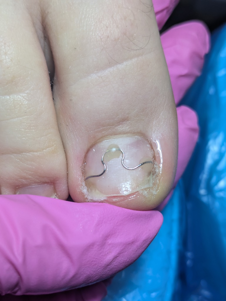 terapia-paznokcia-003