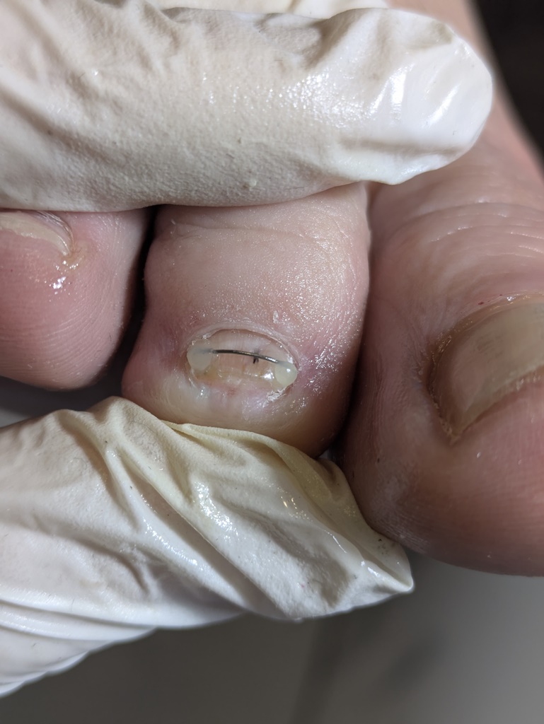 terapia-paznokcia-004